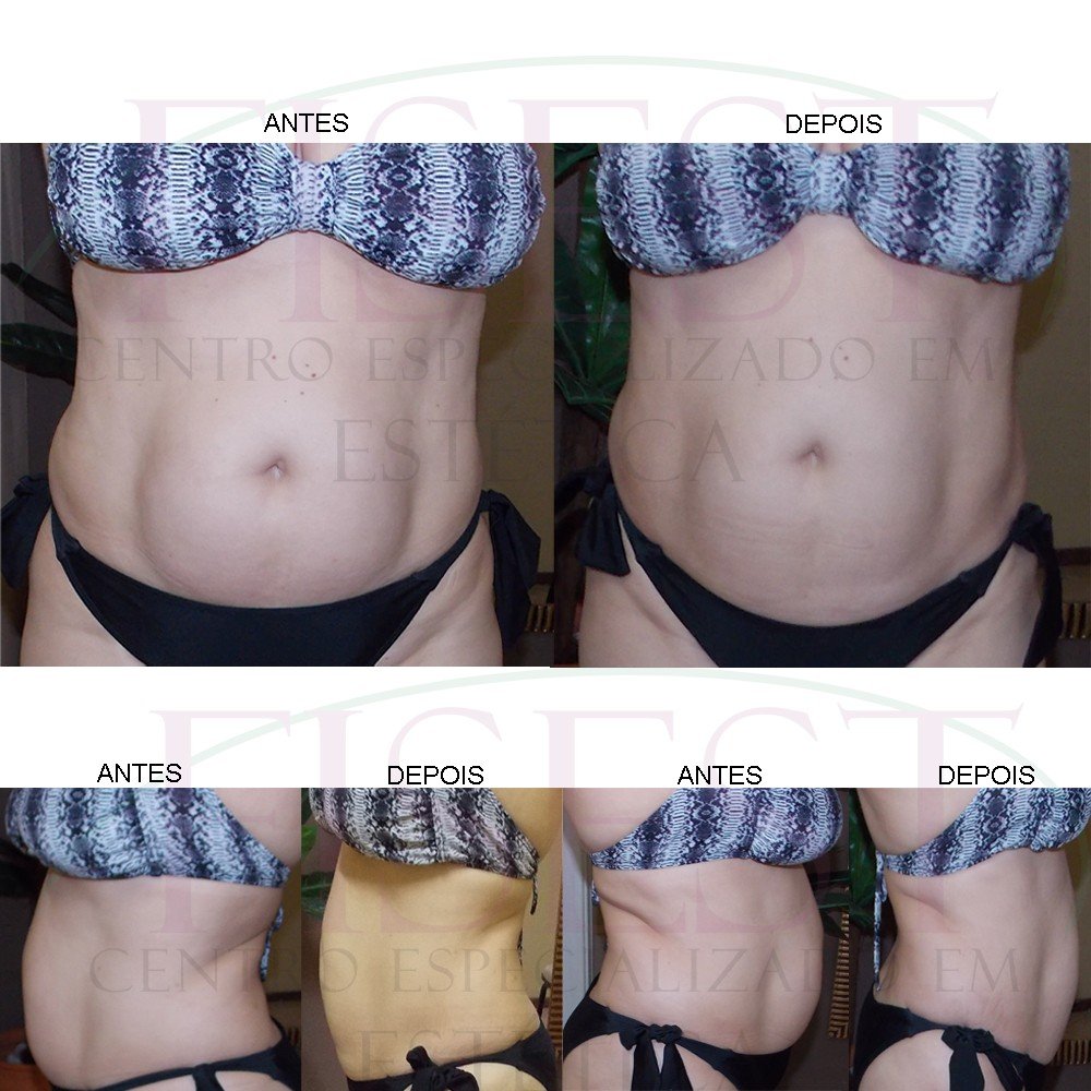 Lipocavitação antes depois JCS gordura localizada Fisest